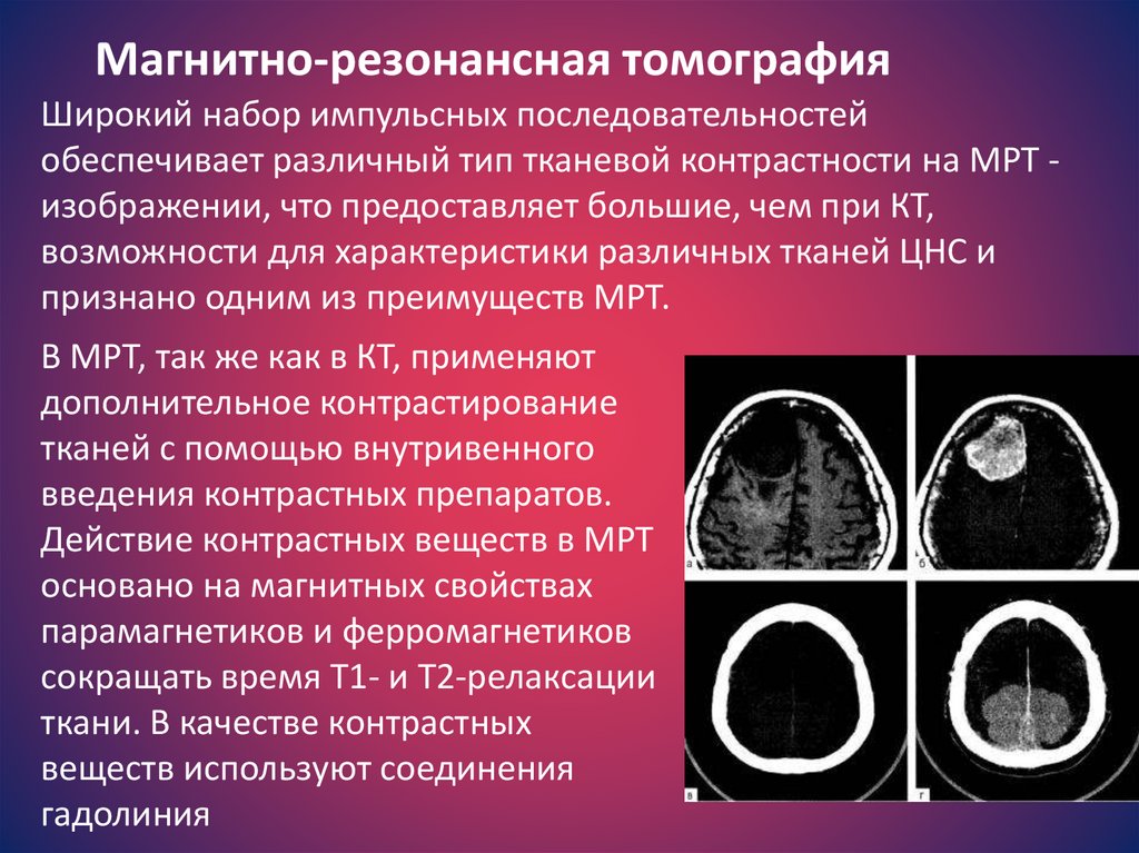 Кт в неврологии презентация