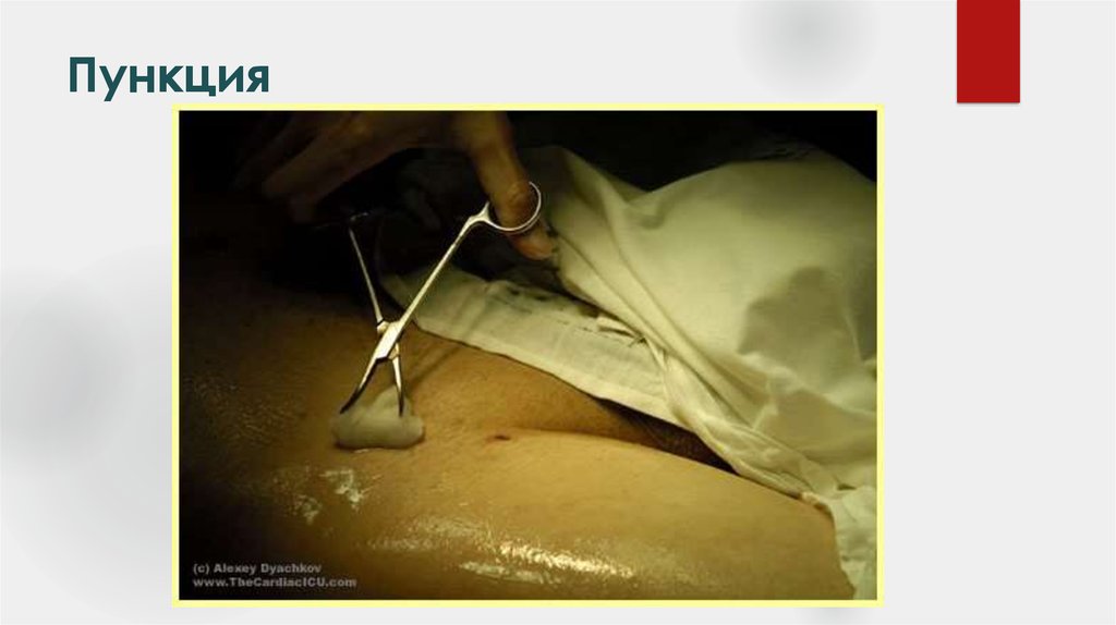 Пункция