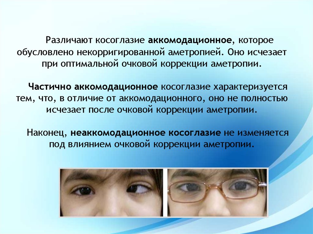 Косоглазие лечение. Содружественное аккомодационное косоглазие. Частично аккомодационное косоглазие. Аккомодативная эзотропия. Косоглазие развивается при поражении.