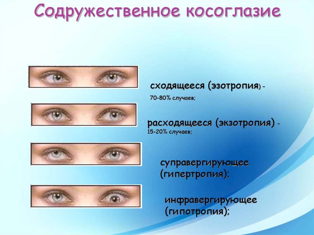 Презентация на тему косоглазие