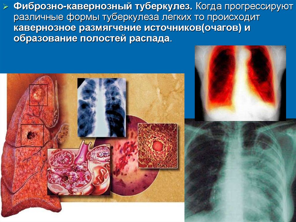 Профилактика туберкулеза презентация