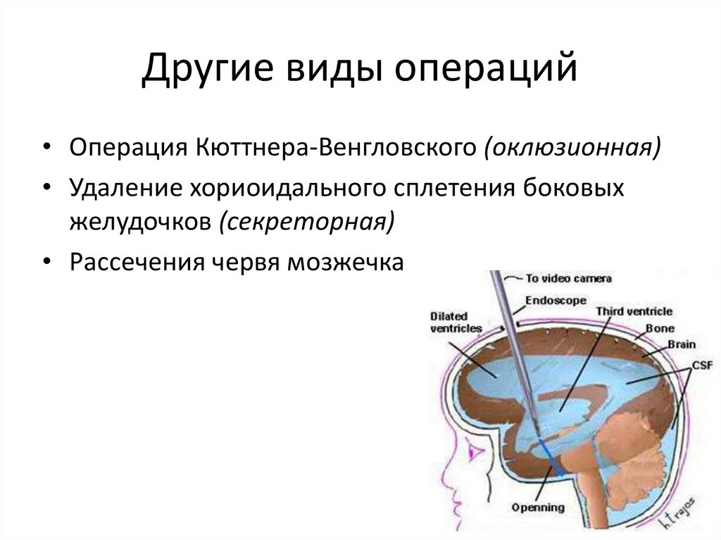 Гидроцефалия операция