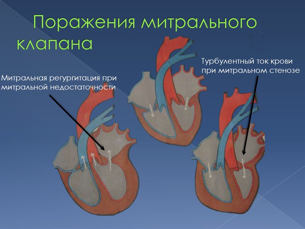 Пролапс митрального клапана с регургитацией 2