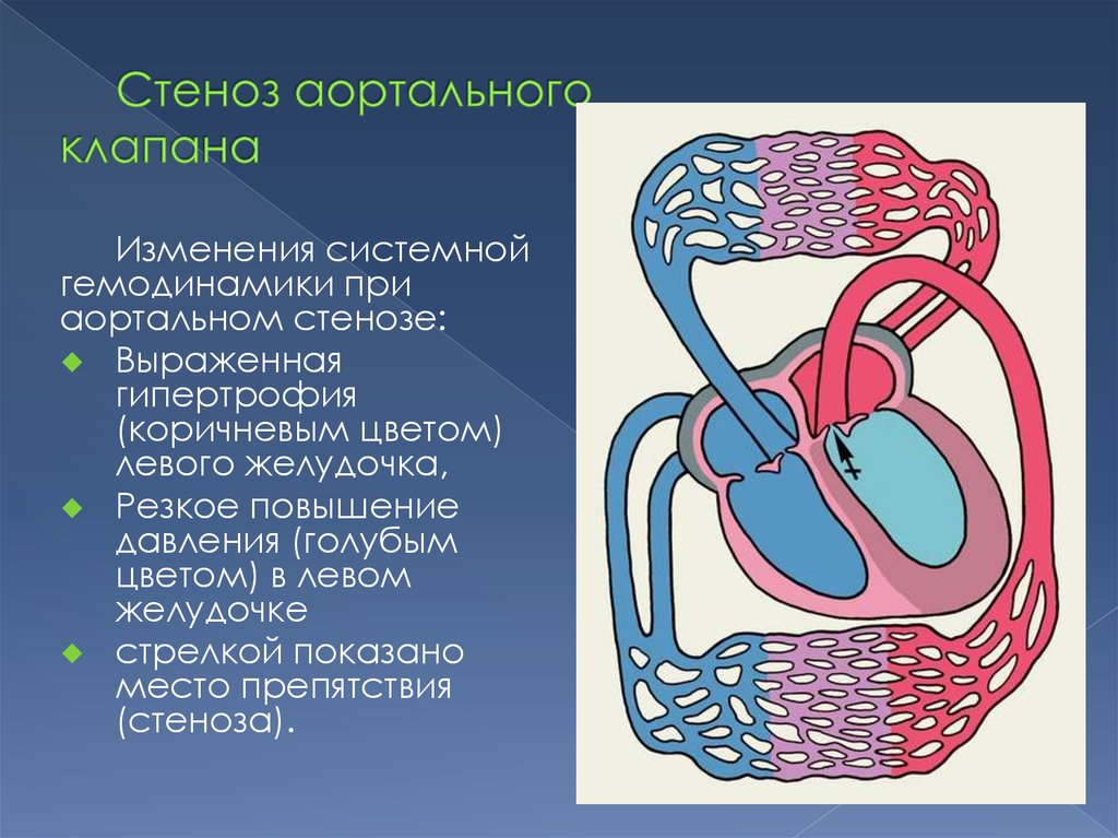 Причины стеноза аортального клапана. Аортальный стеноз гемодинамика. Аортал стеноз гемодинамика. Нарушение гемодинамики при стенозе устья аорты. Стеноз аортального клапана гемодинамика.