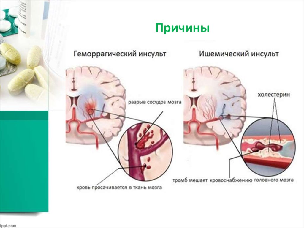 Какие ишемические инсульты. Ишемический инсульт головного мозга клиника. Геморрагический инсульт причины. Ишемический и геморрагический инсульт. Клиника ишемического и геморрагического инсульта.