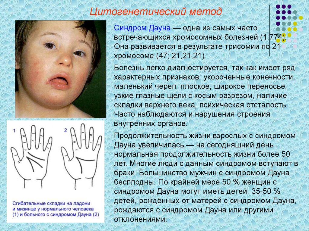 Синдром дауна ребенок живет. Синдром Дауна трисомия по. Хромосомные заболевания синдром Дауна. Хромосомы человека с синдромом Дауна. Синдром Дауна Тип наследования.