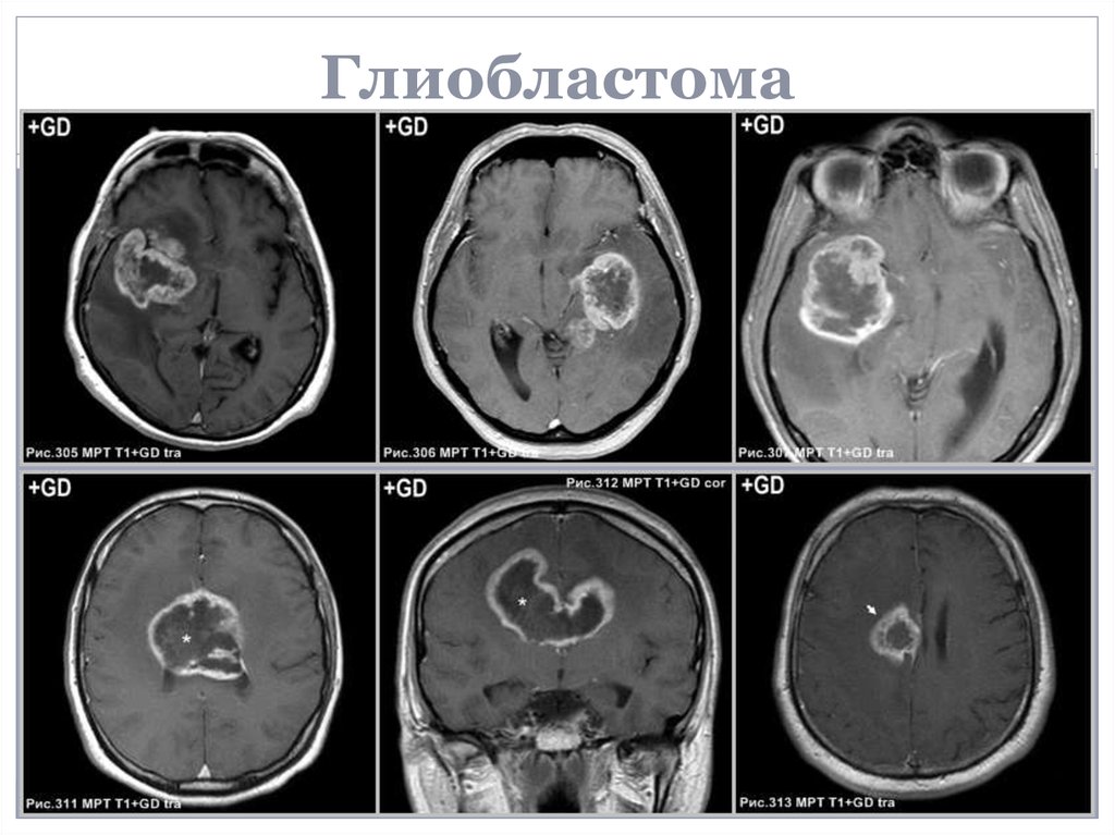 Глиобластома у женщины. Мультиформная глиобластома.