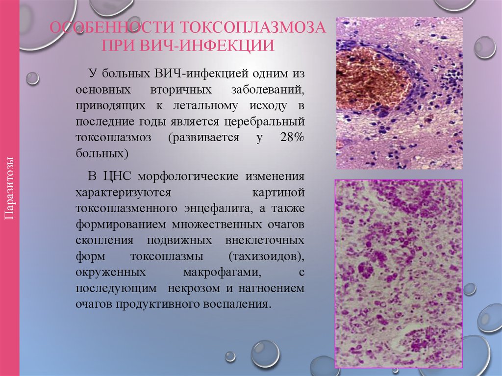 Вторичная болезнь. Токсоплазменная инфекция при ВИЧ. Токсоплазменный энцефалит гистология. Токсоплазмоз при ВИЧ инфекции. Токсоплазмоз головного мозга микропрепарат.