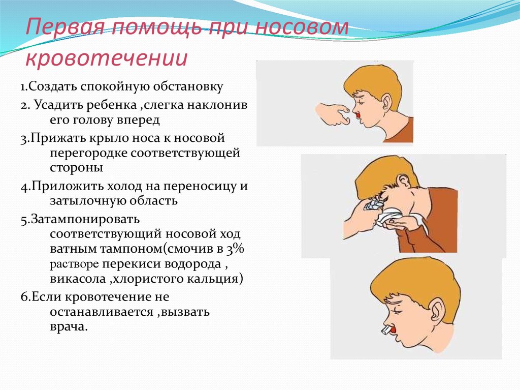 Носовое кровотечение первая помощь. Оказание первой мед помощи при носовом кровотечении. ПМП при носовом кровотечении. Действия неотложной помощи при носовом кровотечении. При носовом кровотечении у детей.