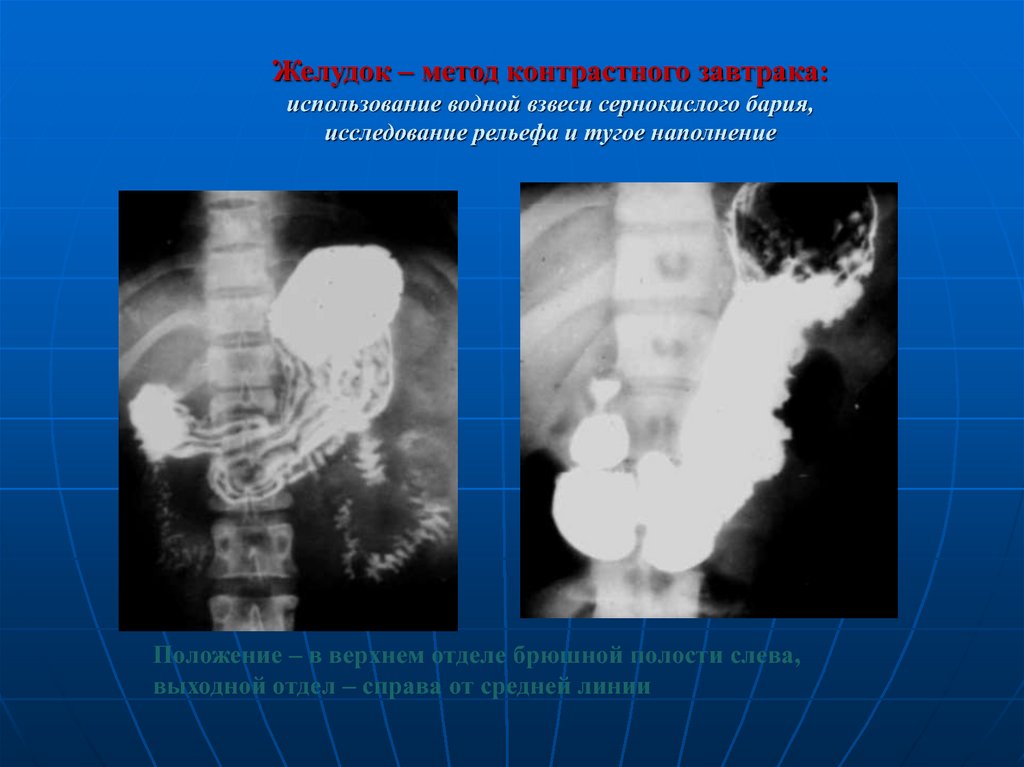 Рентген желудка. Тугое наполнение желудка рентген. Исследование с применением бария. Тугое наполнение желудка контрастным веществом. Метод тугого заполнения желудка.