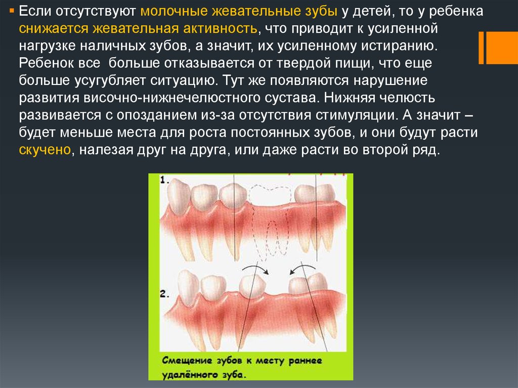 Молочная потеря. Жевательная активность. Потеря временных зубов. Преждевременная утрата временных зубов. Молочные жевательные зубы.