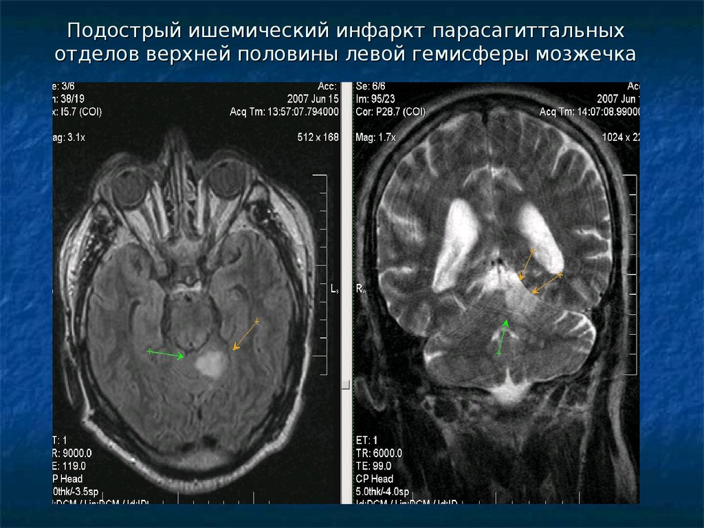 Гемисферы мозжечка изменение. Правая гемисфера мозжечка. Ишемический инфаркт мозжечка. Образование левой гемисферы мозжечка. Опухоль в левой гемисфере мозжечка.