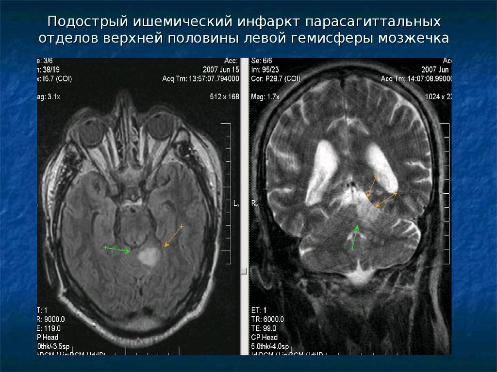 Мр картина образования. Правая гемисфера мозжечка. Левая гемисфера мозжечка. Ишемический инфаркт мозжечка. Образование левой гемисферы мозжечка.