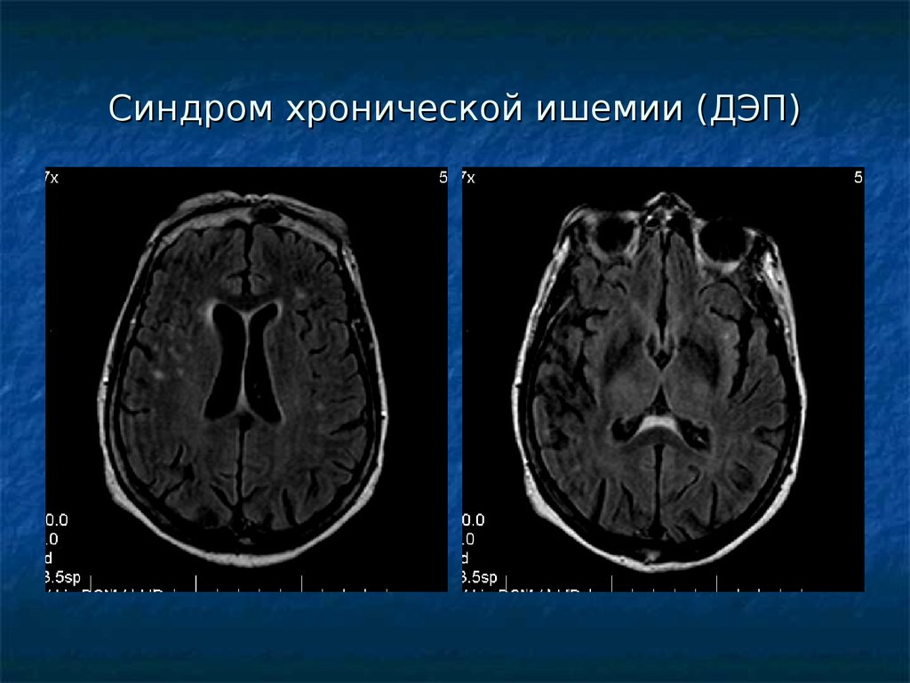 Ишемия мозга мрт. Токсическое поражение головного мозга кт. Ишемия головного мозга на мрт. Ишемическое поражение головного мозга на мрт. Токсическое поражение мозга мрт.