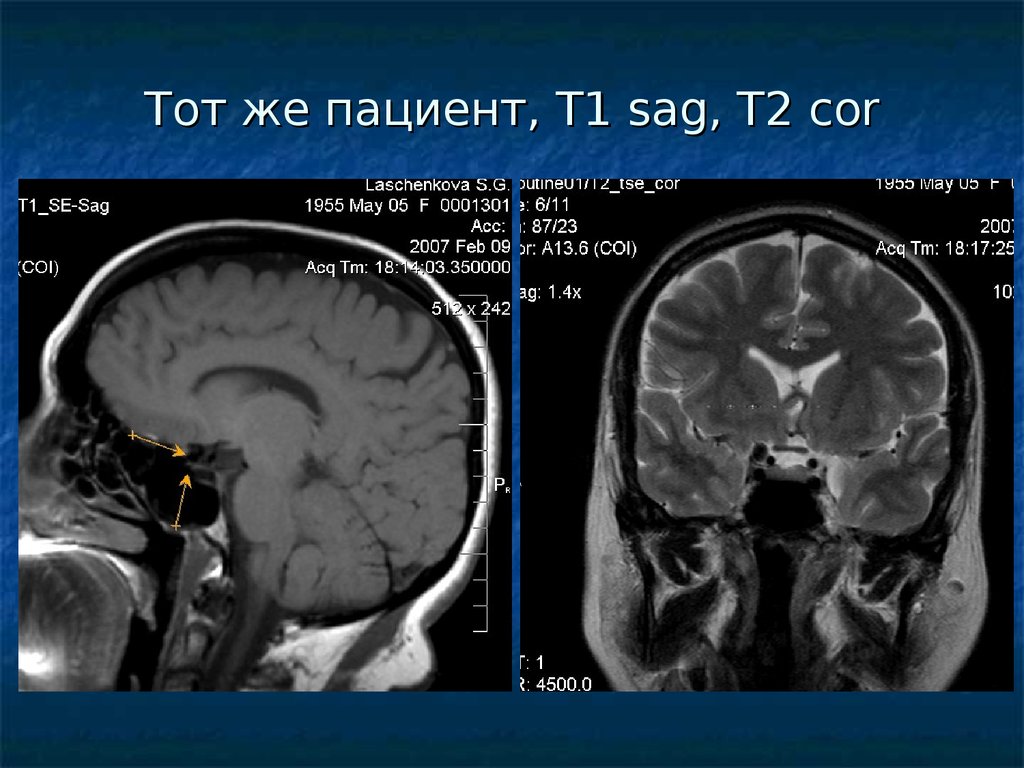 Другие уточненные поражения головного мозга. Т1 sag. Поражение головного мозга при гистеоцитозе.