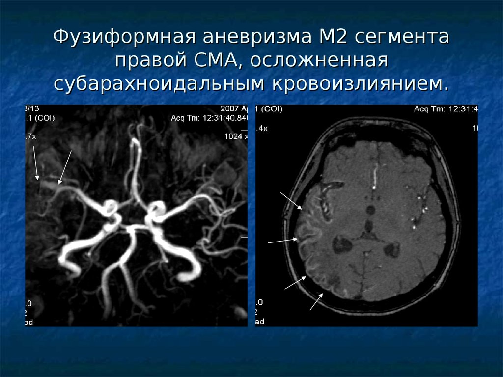 Сма мозга. Аневризма средней мозговой артерии кт. Аневризма средней мозговой артерии мрт. Сегмент м1 сосудов головного. Фузиформная аневризма основной артерии кт.