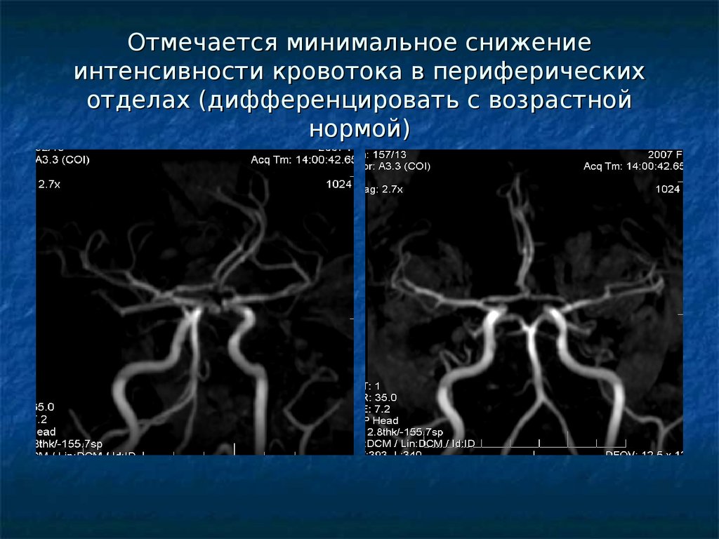 Сосуды головного мозга норма. Кт ангиография интракраниальных артерий. Интракраниальные артерии головного мозга. Кт ангиография сонных артерий. МР-ангиография интракраниальных сосудов.