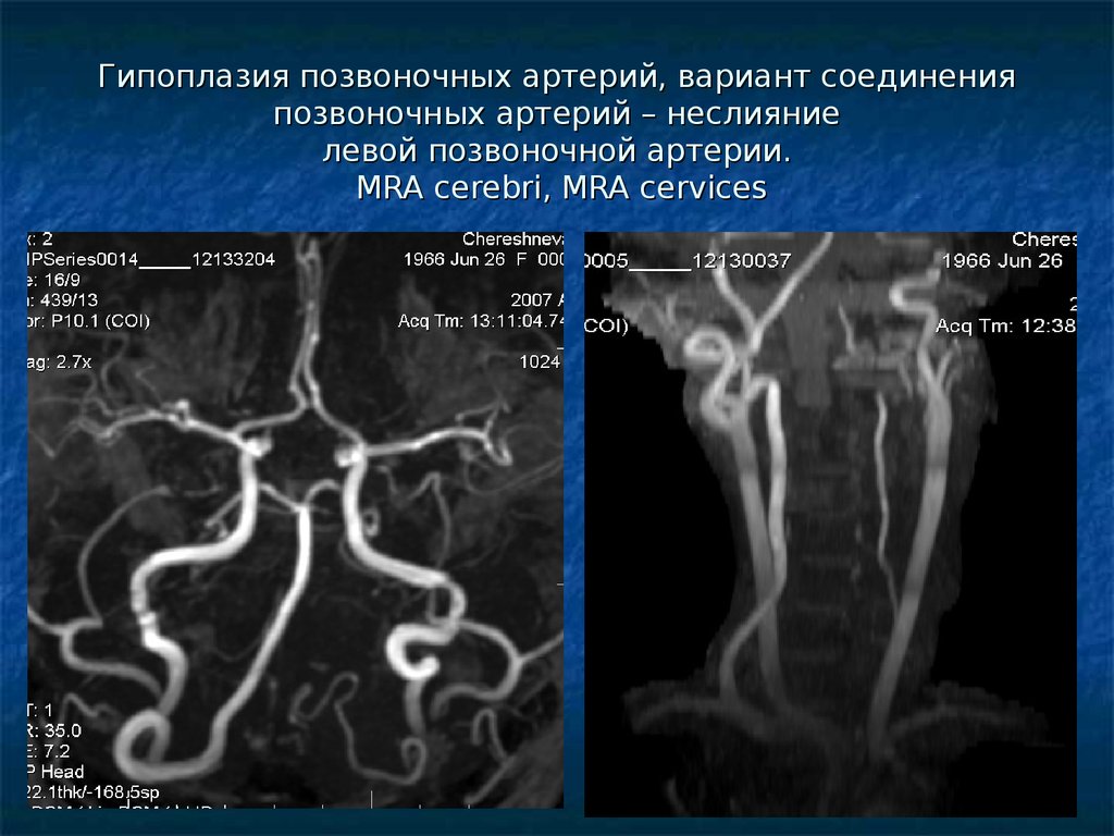 Гипоплазия правой артерии мозга. Гипоплазия р1 сегмента мозговой артерии. Гипоплазия v4 сегмента левой позвоночной артерии. Гипоплазия позвоночной артерии кт. Гипоплазия v4 сегмента правой позвоночной артерии.