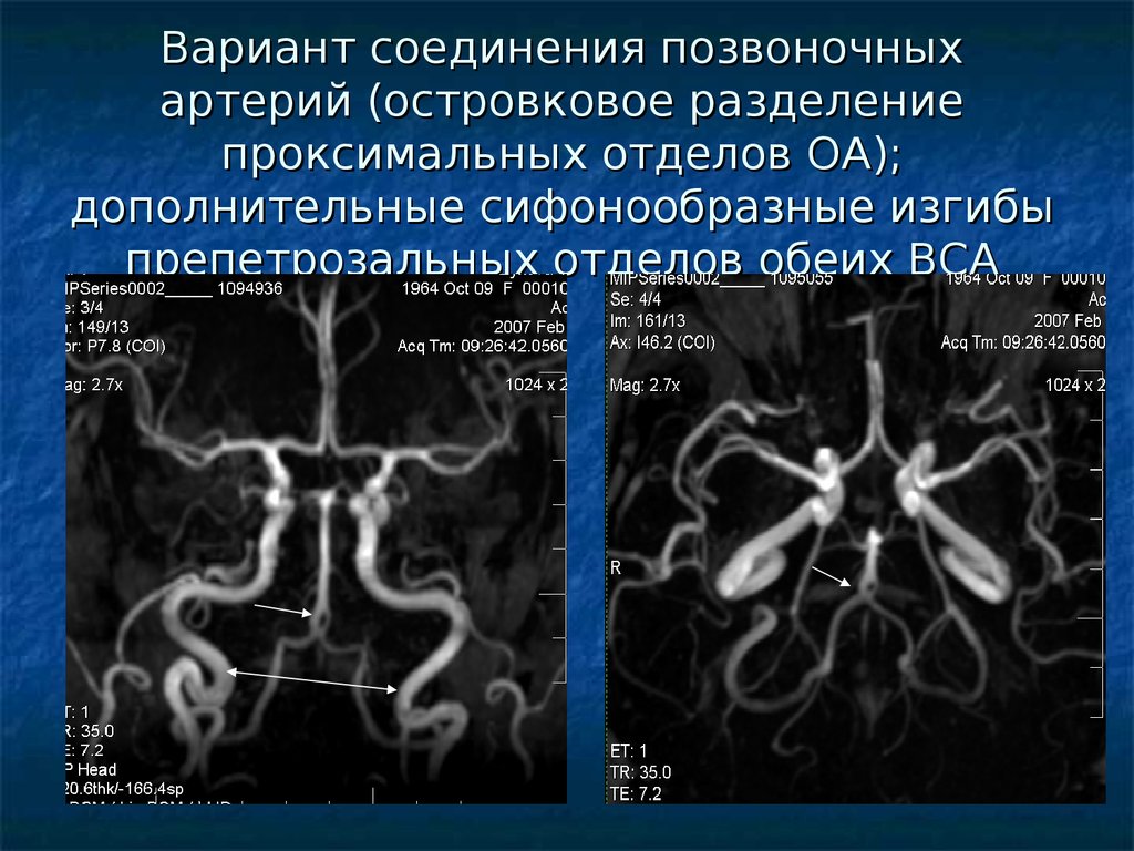 Гипоплазия правой головного мозга. ВСА артерия сегменты. Сегменты сонной артерии мрт. V4 сегментов позвоночных артерий. Гипоплазия позвоночной артерии кт.