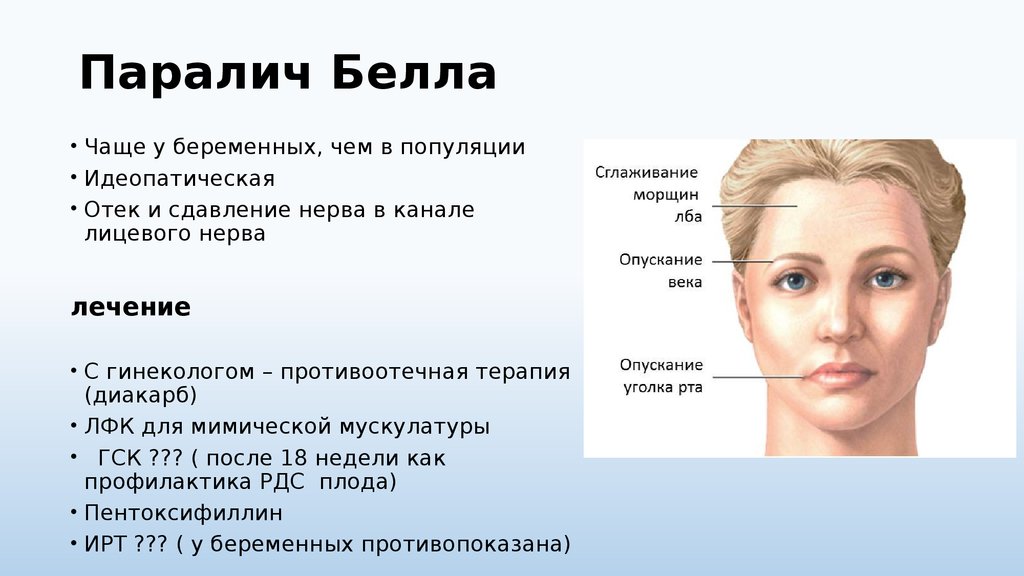Неврит лицевого нерва рекомендации. Неврит лицевого нерва симптомы глаза. Паралич мимической мускулатуры.
