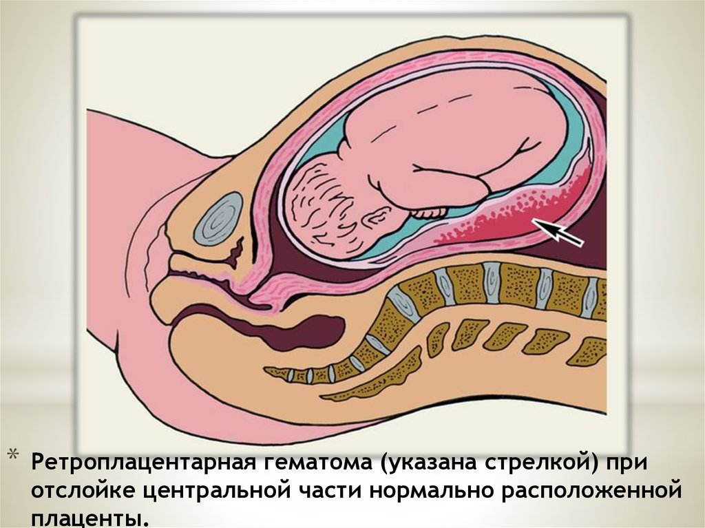 Процесс образования новых родов. Субтотальная отслойка плаценты. Ретроплацентарная гематома и ПОНРП. Преждевременная отслойка плаценты в родах.