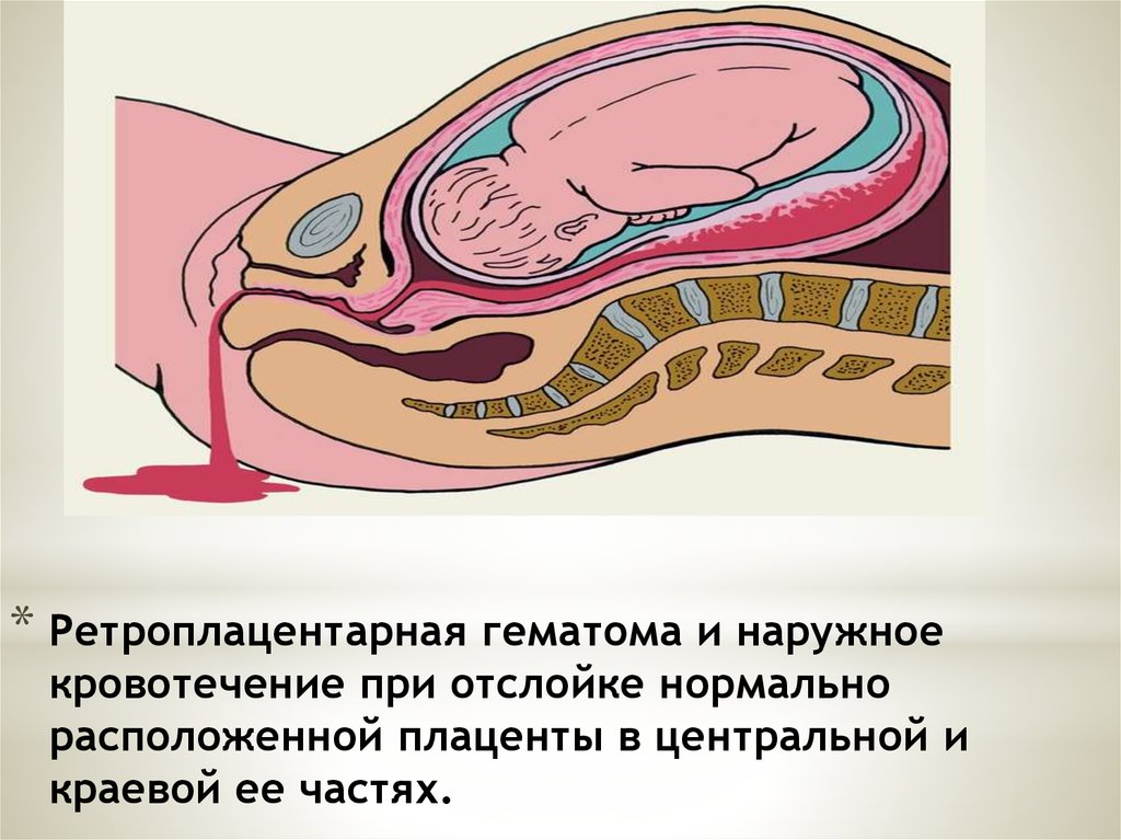 Гематома 1 триместр. Отслойка плаценты патанатомия. Ретроплацентарная гематома. Ретроплацентарная гематома образуется. Отслойка плаценты подоболочечная.