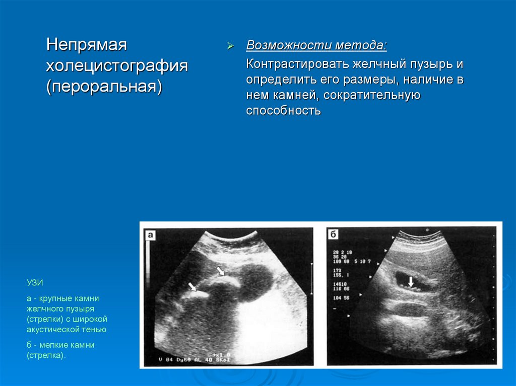 Узи желчного пузыря с определением функции