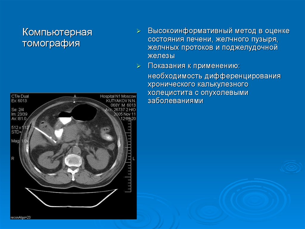 Желчнокаменная болезнь картинки для презентации