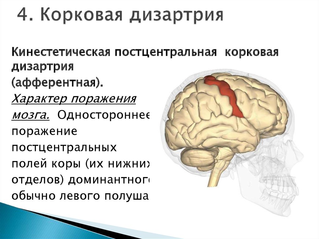 Мозжечковая форма дизартрии