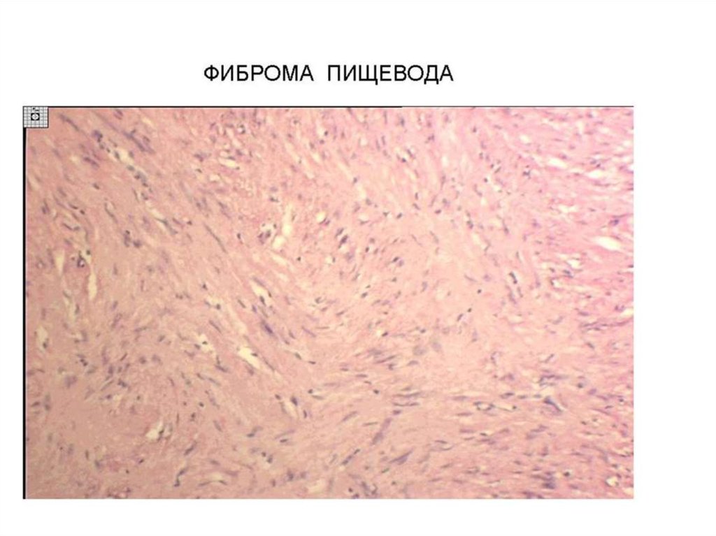 Фиброма кожи гистология фото у человека что это такое фото симптомы и лечение