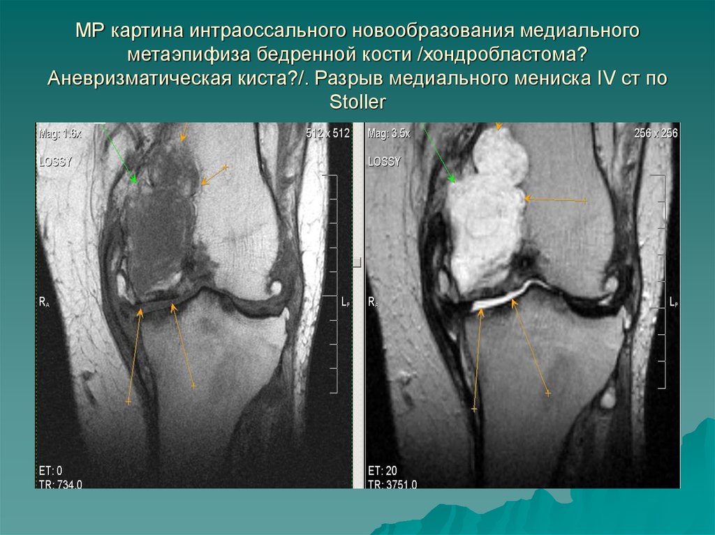 Мр картина кисты. Аневризматическая костная киста бедренной кости. Костная киста бедренной кости мрт. Аневризматическая костная киста бедренной кости на мрт. Аневризматическая киста бедра.