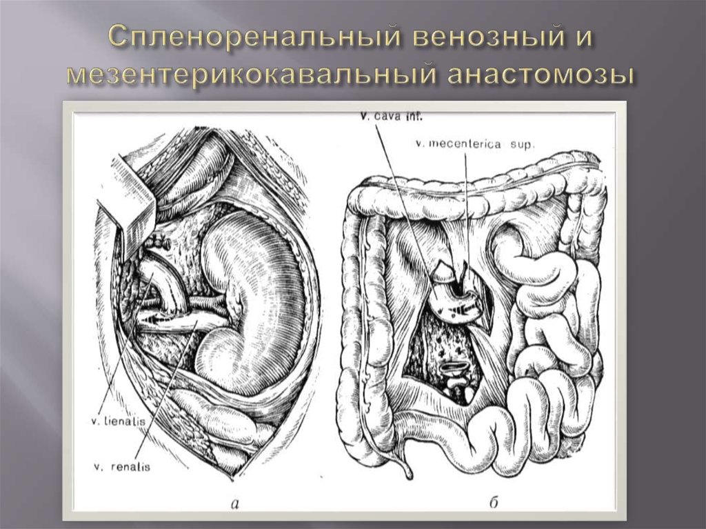 Спленоренальный венозный и мезентерикокавальный анастомозы