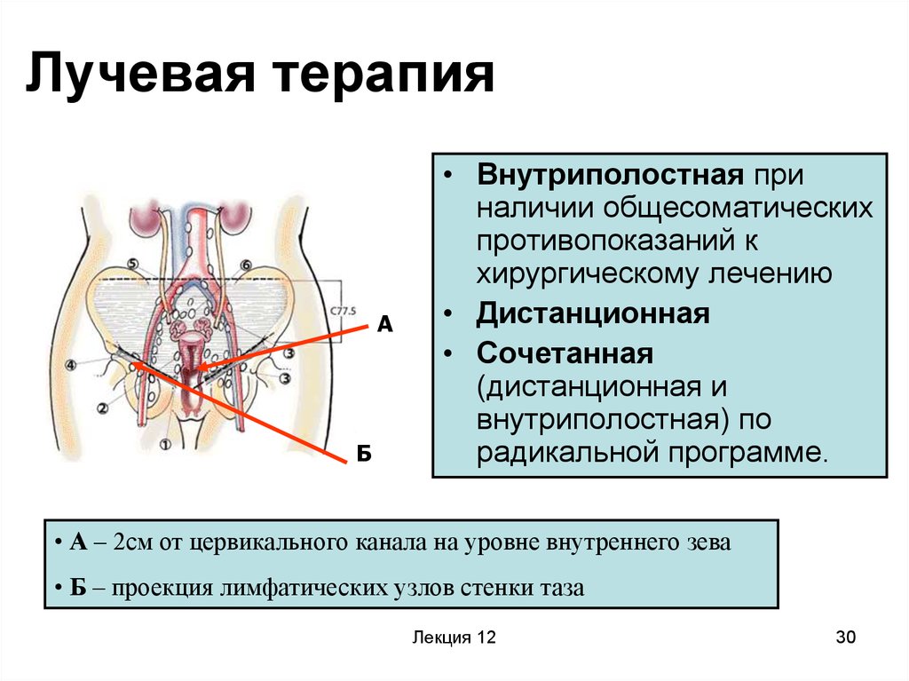 Операция после рака шейки матки