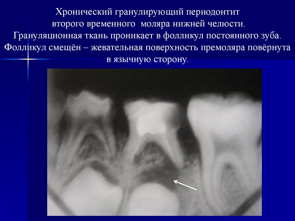 Лечение острого и хронического периодонтита временных зубов