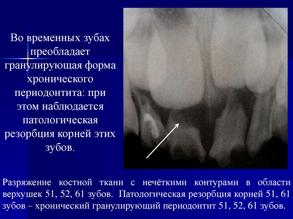 Разряжение костной ткани. Разряжение костной ткани зубов. Участок разряжения костной ткани. Очаг разряжения костной структуры что это. Разряжение костной структуры.