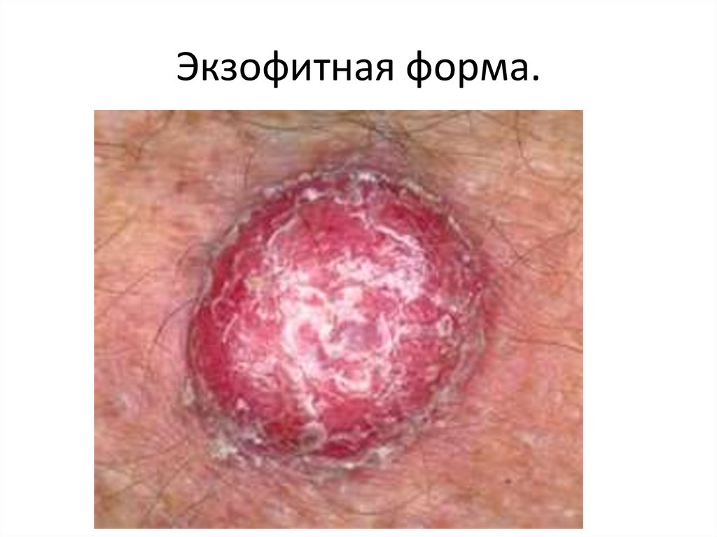 Экзофитная форма.