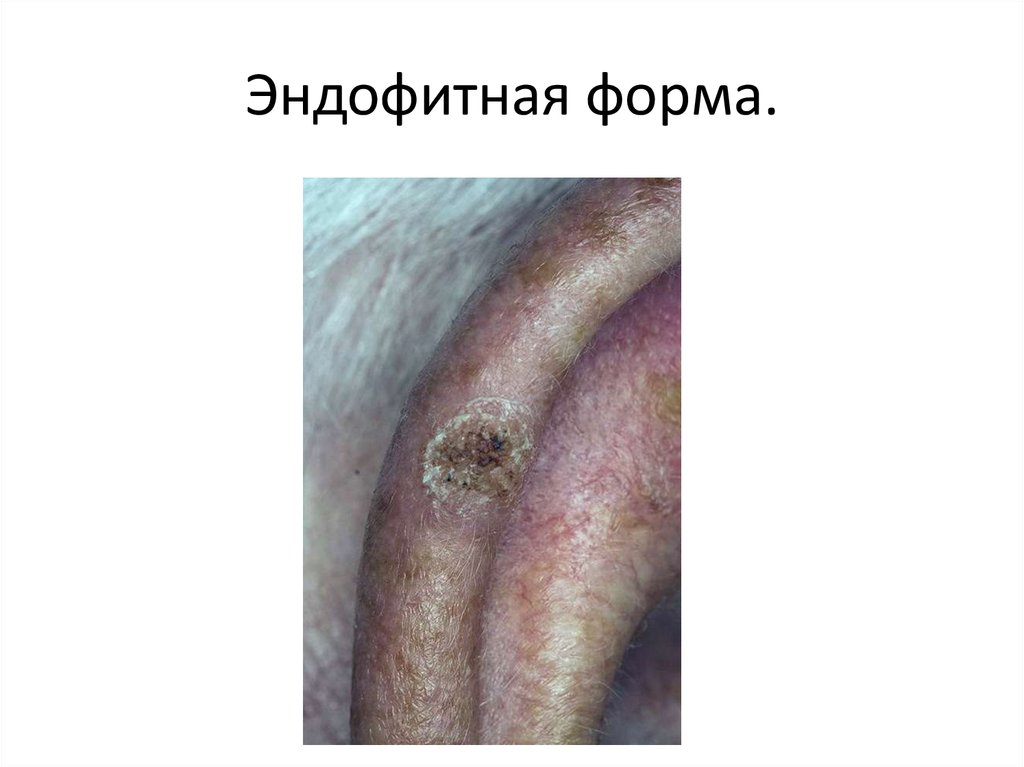 Эндофитная форма.