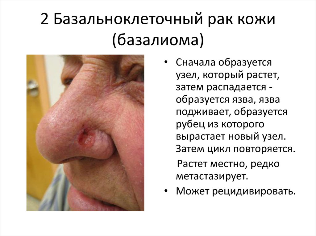 2 Базальноклеточный рак кожи (базалиома)