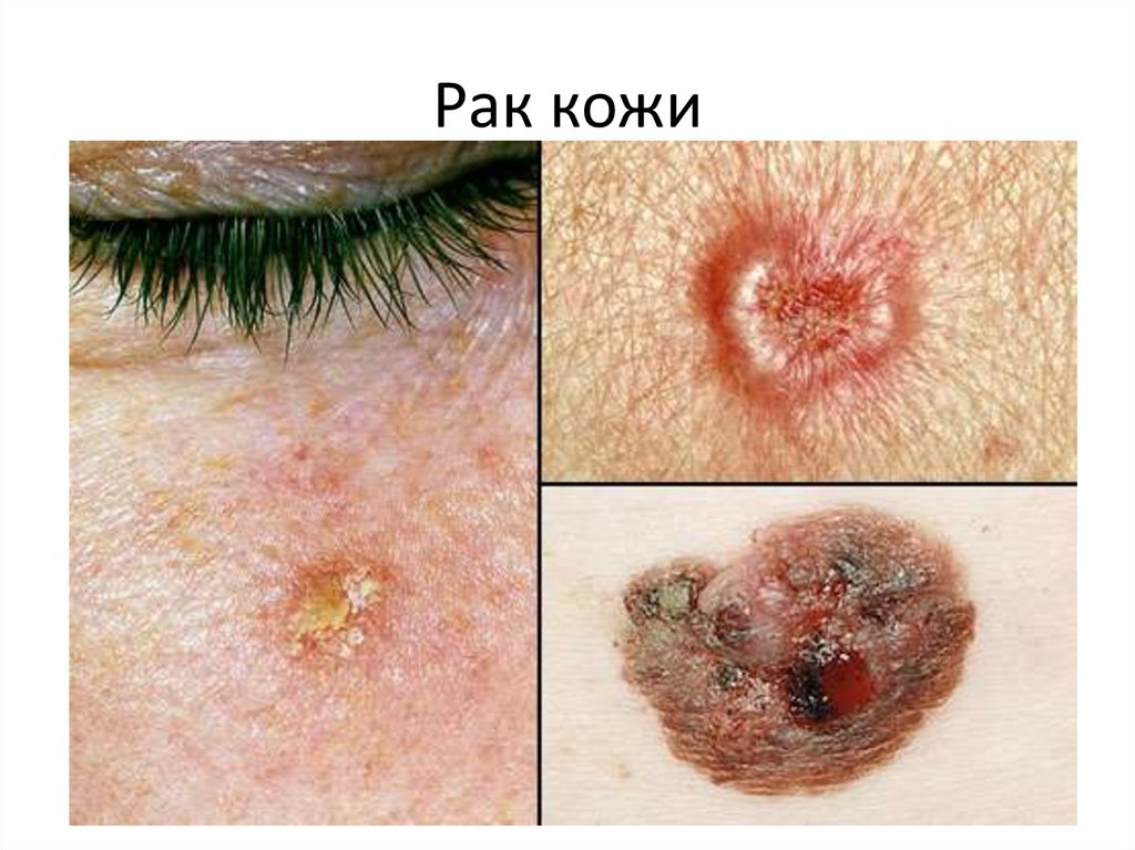 Рак кожи