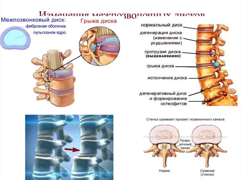 Что чаще всего характеризует нарушение осанки высокий рост увеличение межпозвоночных дисков