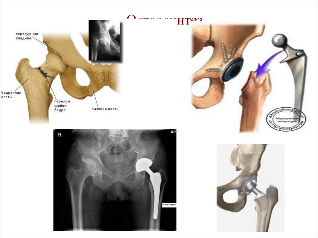 Головка бедренной. Краевой перелом вертлужной впадины. Остеосинтез перелома вертлужной впадины. Перелом вертлужной впадины тазобедренного сустава классификация. Вертлужная кость тазобедренного сустава.