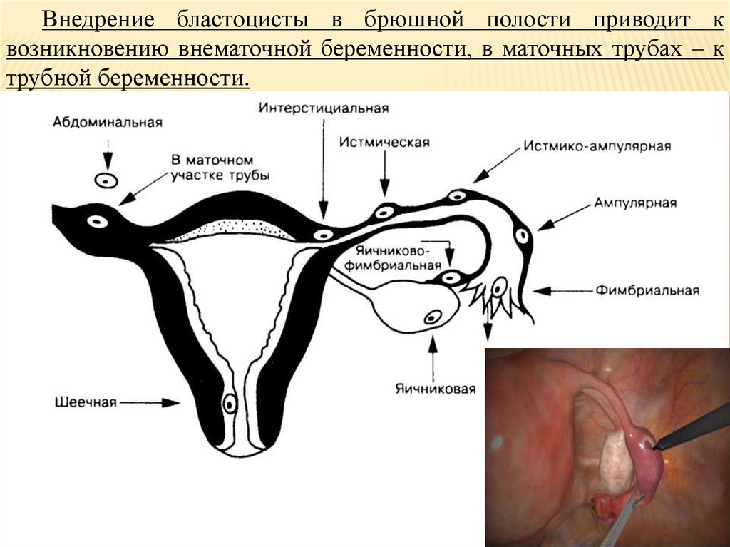 Брюшная беременность. Брюшная внематочная беременность. Ампулярная Трубная беременность. Абдоминальная брюшная беременность что такое. Эктопическая беременность в брюшной полости.