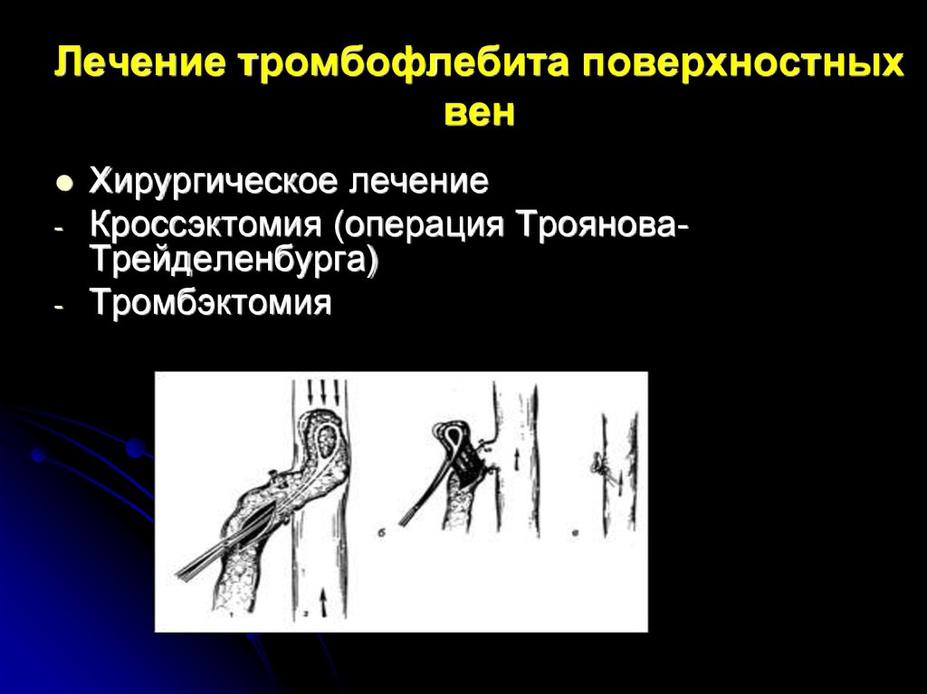 Тромбозы глубоких вен рекомендации