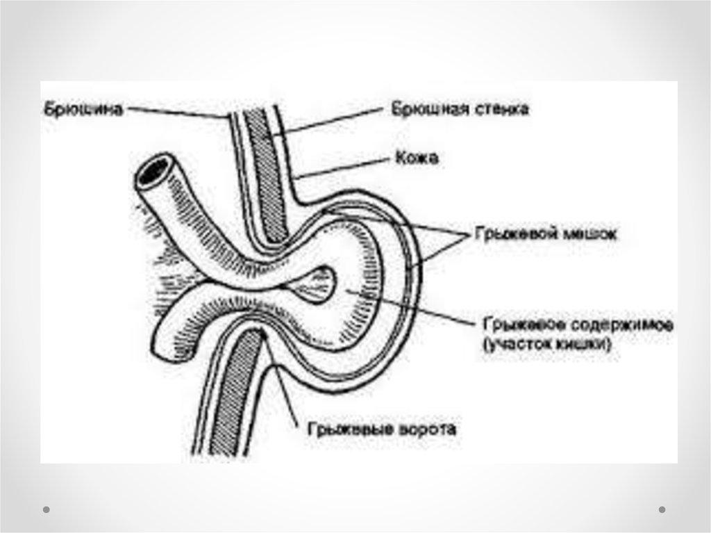 Грыжевой мешок. Грыжевой мешок строение. Составные элементы грыжи. Пупочная грыжа схема анатомия.