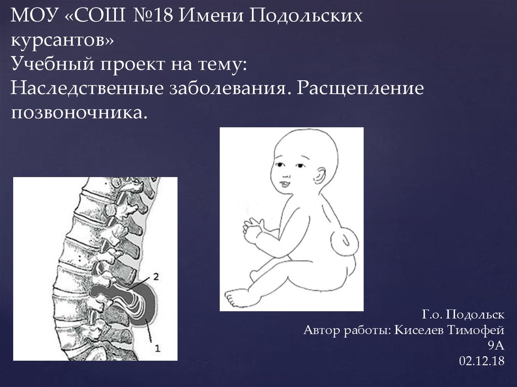 Расщепление позвоночника презентация