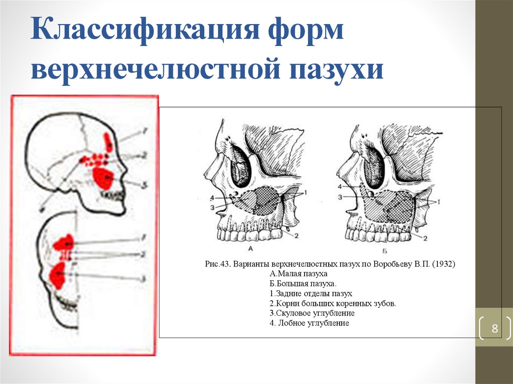 Правая верхнечелюстная пазуха. Строение стенок гайморовой пазухи. Выводной проток верхнечелюстной пазухи.