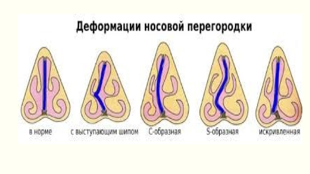 Искривление перегородки носа фото