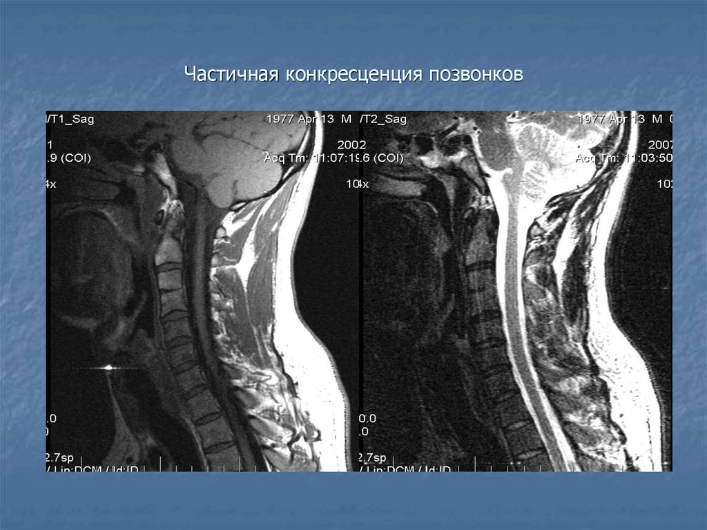 Позвоночник с5. Частичная конкресценция тел позвонков с5/с6. Конкресценция позвонков это. Конкресценция позвонков мрт. Частичная конкресценция на кт.