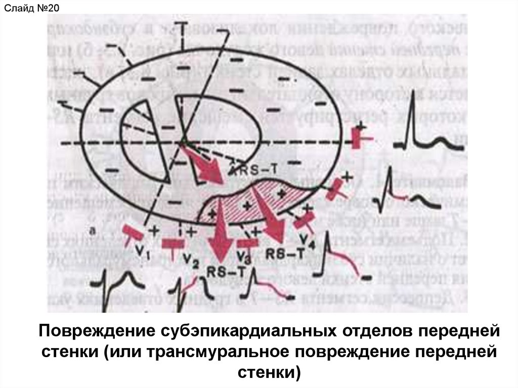 Субэндокардиальная ишемия передней стенки что это