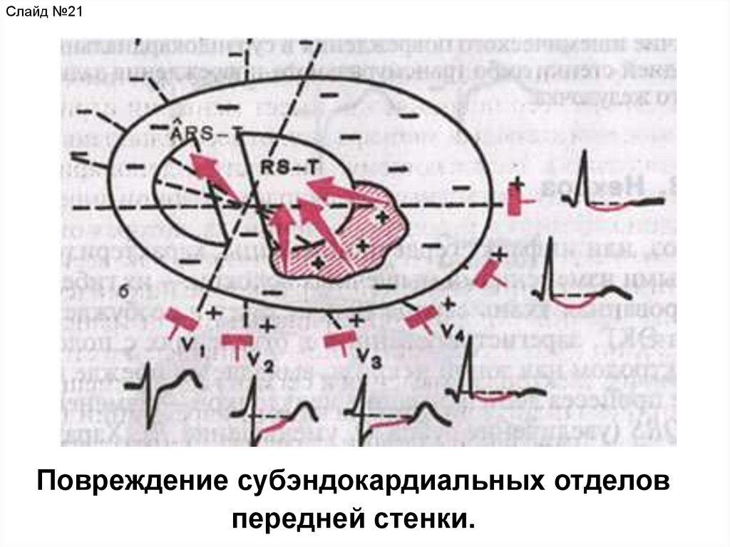 Субэндокардиальная ишемия боковой стенки